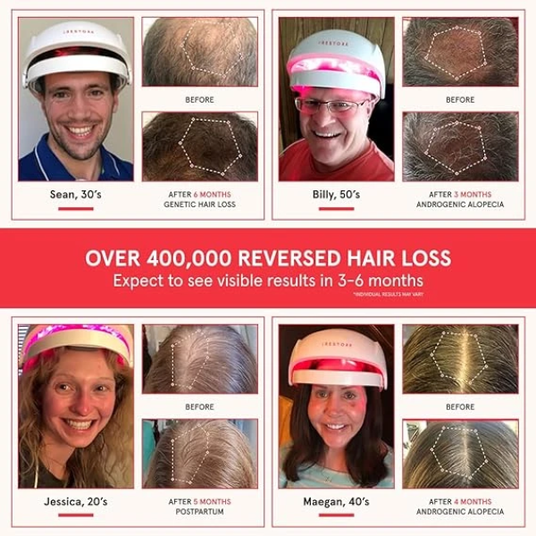 iRestore Essential Laser Hair Growth System 雷射生髮帽 2