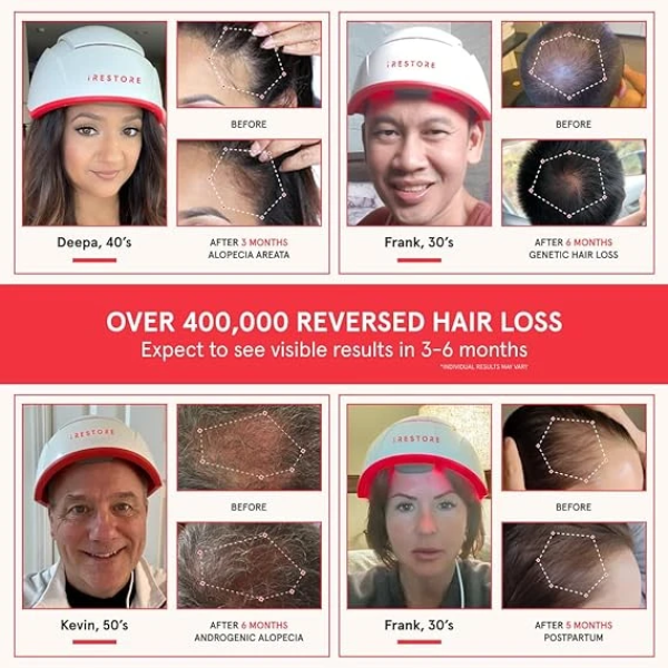 iRestore Professional 282 FDA Cleared Laser Hair Growth Device 雷射生髮帽 2
