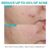 La Roche-Posay Effaclar Salicylic Acid Acne Treatment to Minimize Pores 理膚寶水 精華液 4