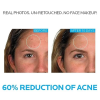 La Roche-Posay Effaclar Dermatological 3 Step Acne Treatment System 理膚寶水抗痘組 5