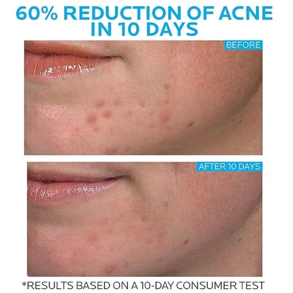 La Roche-Posay Effaclar Duo Dual Action Acne Spot Treatment Cream with Benzoyl Peroxide Acne Treatment 理膚寶水 抗痘保養品 3